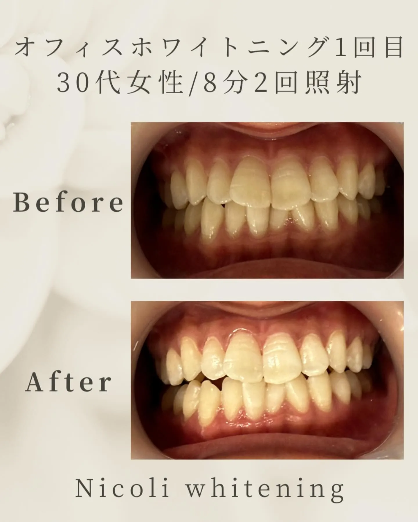 オフィスホワイトニング1回目のお客様です🌟