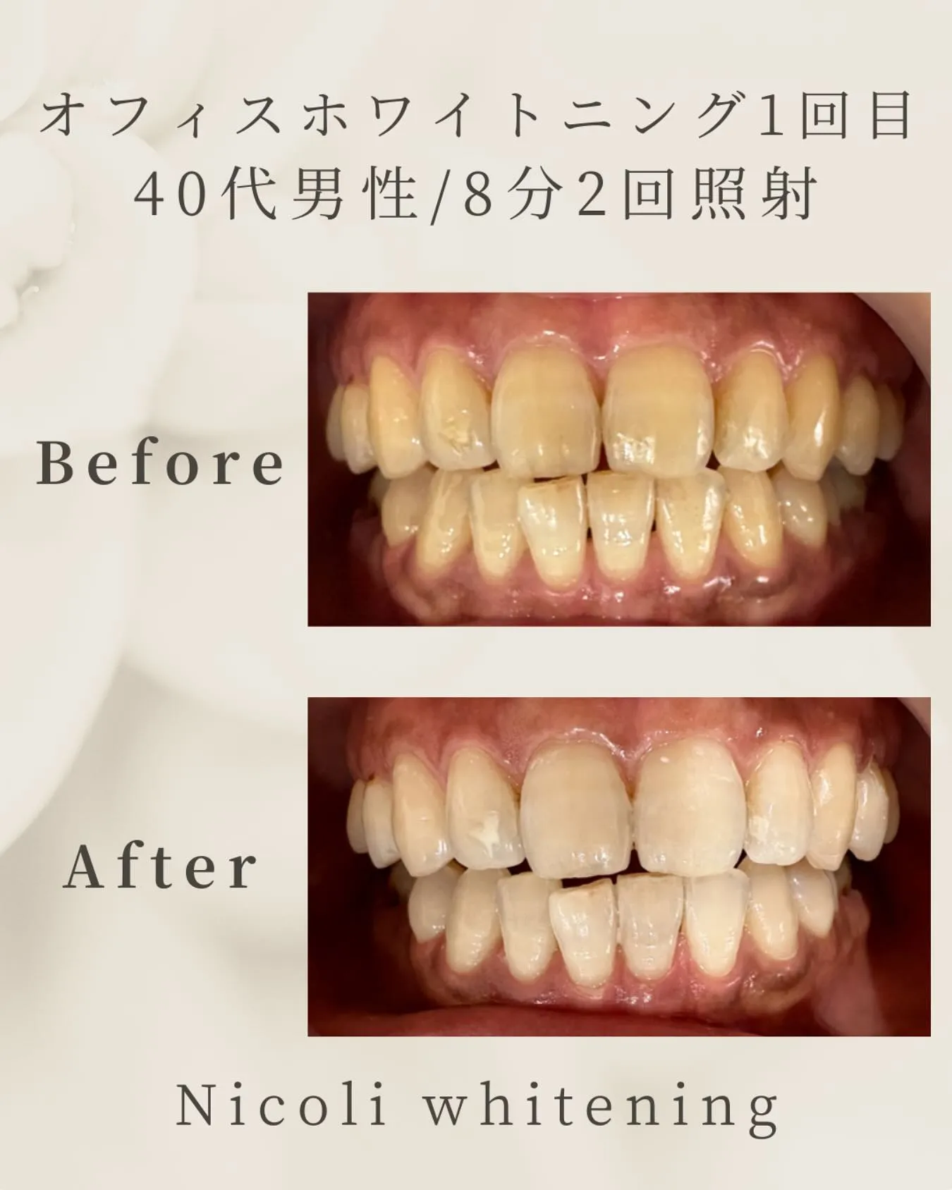 オフィスホワイトニング1回目のお客様です🌟