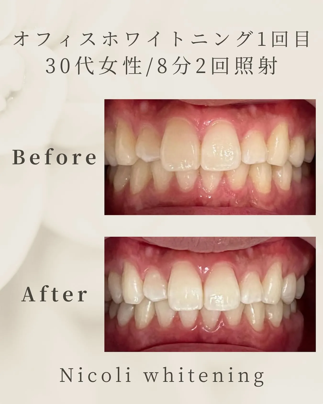 オフィスホワイトニング1回目のお客様です🌟