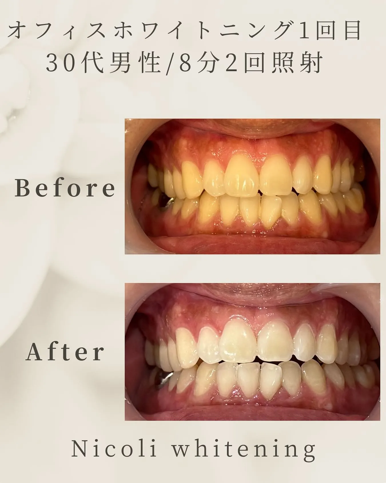 オフィスホワイトニング1回目のお客様です🌟