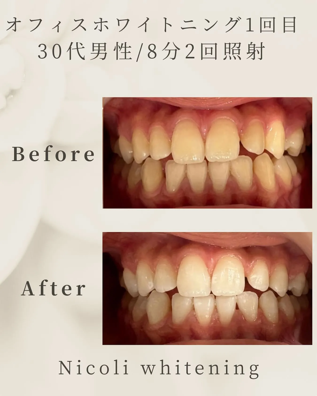オフィスホワイトニング1回目のお客様です🌟
