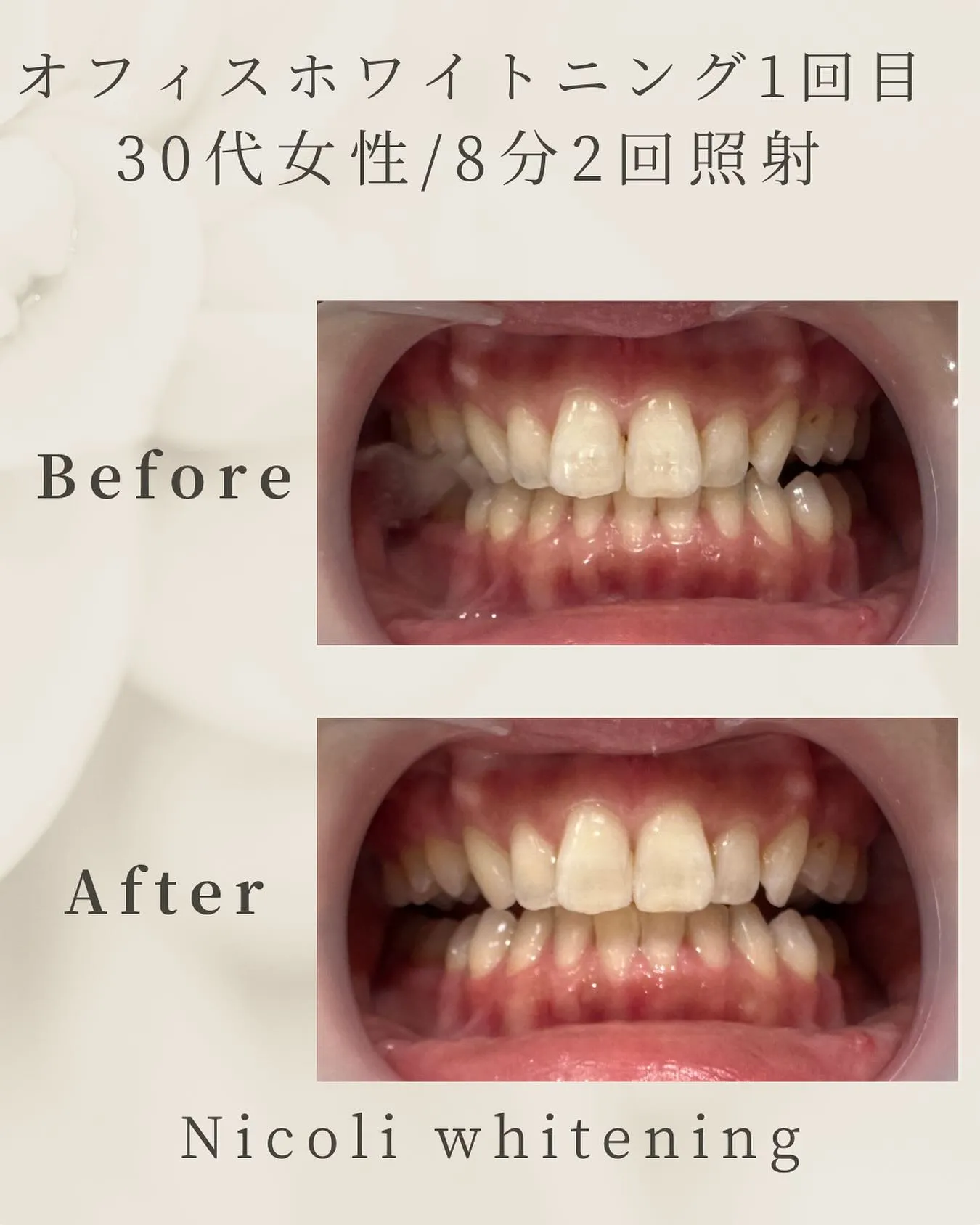 オフィスホワイトニング1回目のお客様です🌟