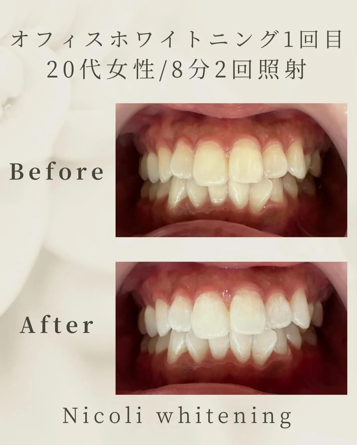 オフィスホワイトニング1回目のお客様です🌟