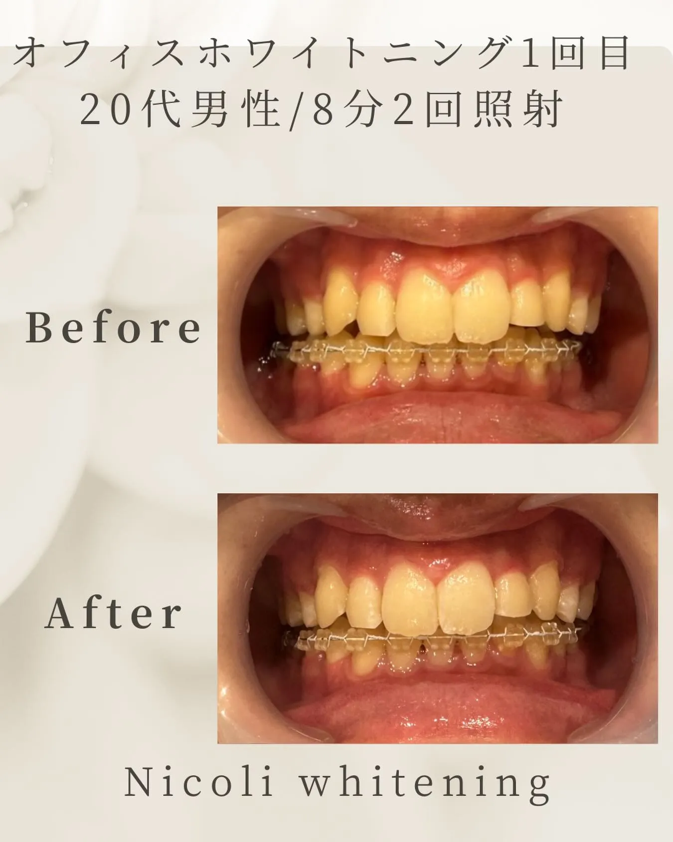 オフィスホワイトニング1回目のお客様です✨