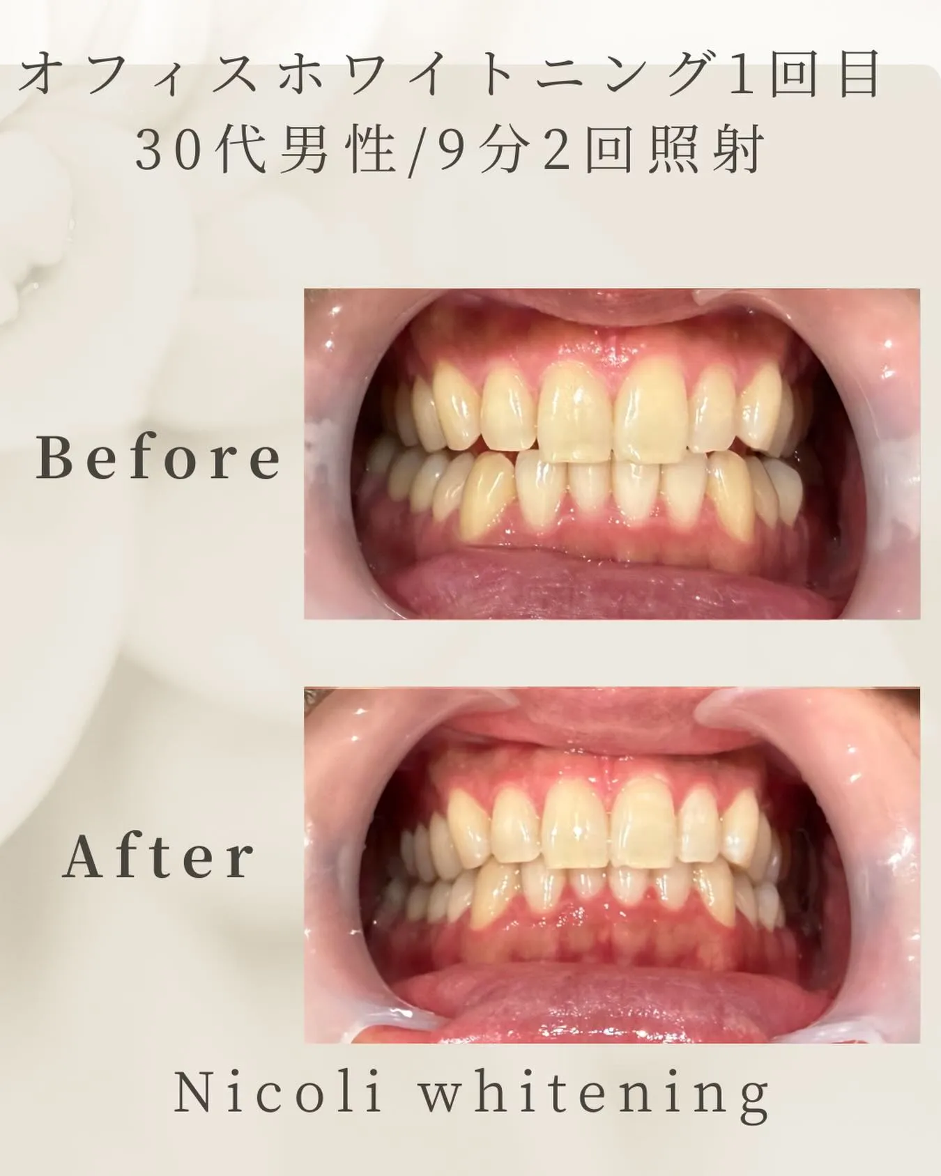 オフィスホワイトニング1回目のお客様です🌟